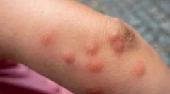 Alergia na ugryzienie klaop