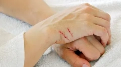 Choroby przenoszone przez ukąszenia i zadrapania