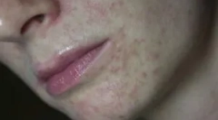 Demodekoza: co to jest objawy i leczenie