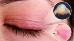 Demodekoza: przyczyny, objawy i leczenie