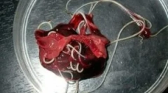 Robaki w tkankach wątrobowych