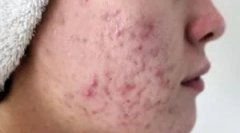 Jak transmitowana jest demodicoza?