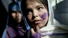 Jak zostać zakażona leishmeni: objawy i leczenie leiszmaniozy