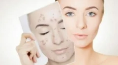 Leczenie demodkicy na twarzy osoby