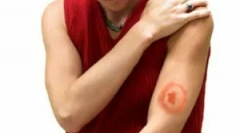 Leczenie borreliozy belek