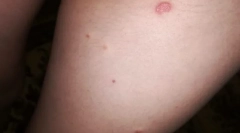 Dlaczego niektórzy ludzie gryzą pchły i nie ma innych