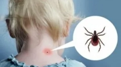 Reakcja ciała i kleszcza przestrzeń