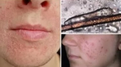 Analiza dostawy na demodecosis