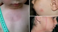 Objawy i leczenie borreliozy w dziecku