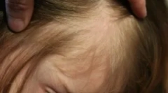 Wszy i szorty we włosach w dziecku